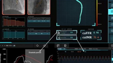 冠狀動(dòng)脈血流儲備分?jǐn)?shù)測量系統(tǒng)（蘇州潤邁德）